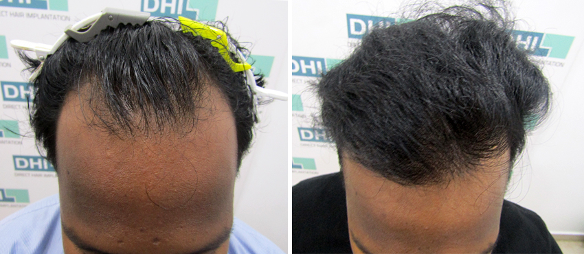 DHI before & after hair transplant results